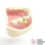 Dental Fender Wedge, Matrizen/Keil-Kombination 50er Packung