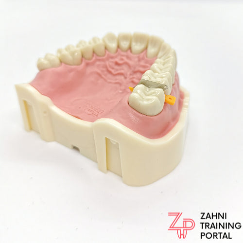 Dental Fender Wedge, Matrizen/Keil-Kombination 50er Packung